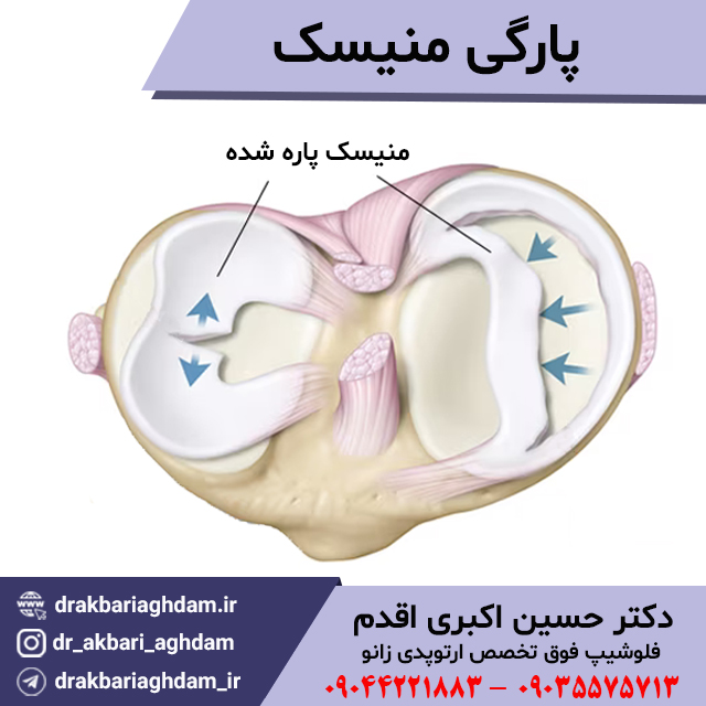 پارگی-منیسک-زانو