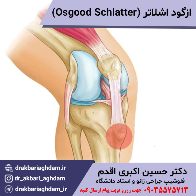 ازگود-اشلاتر-Osgood-Schlatter