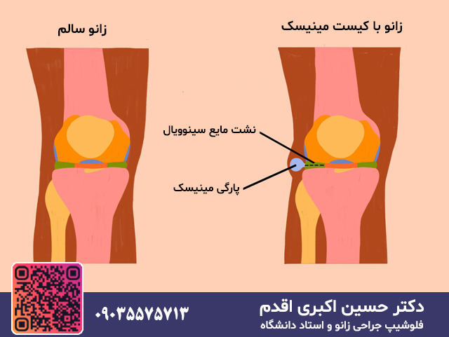 زانوی با کیست مینیسک