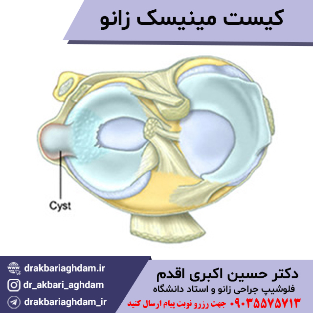 کیست-مینیسک-زانو