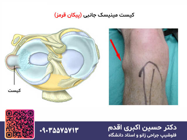 کیست مینیسک